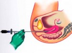 Гистероскопия матки: современный способ устранения внутриматочной патологии