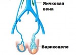 Современные подходы к лечению варикоцеле