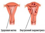 Внутренний эндометриоз